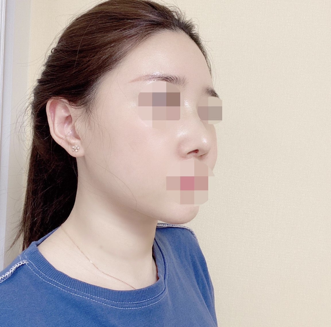 수술후기이미지