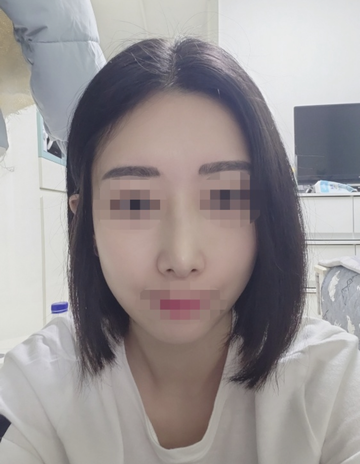 수술후기이미지