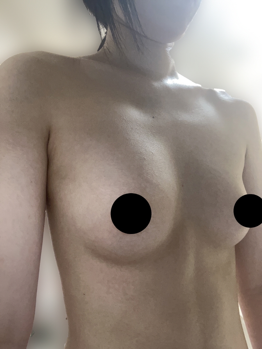 수술후기이미지