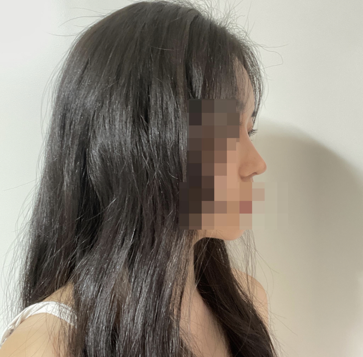 수술후기이미지