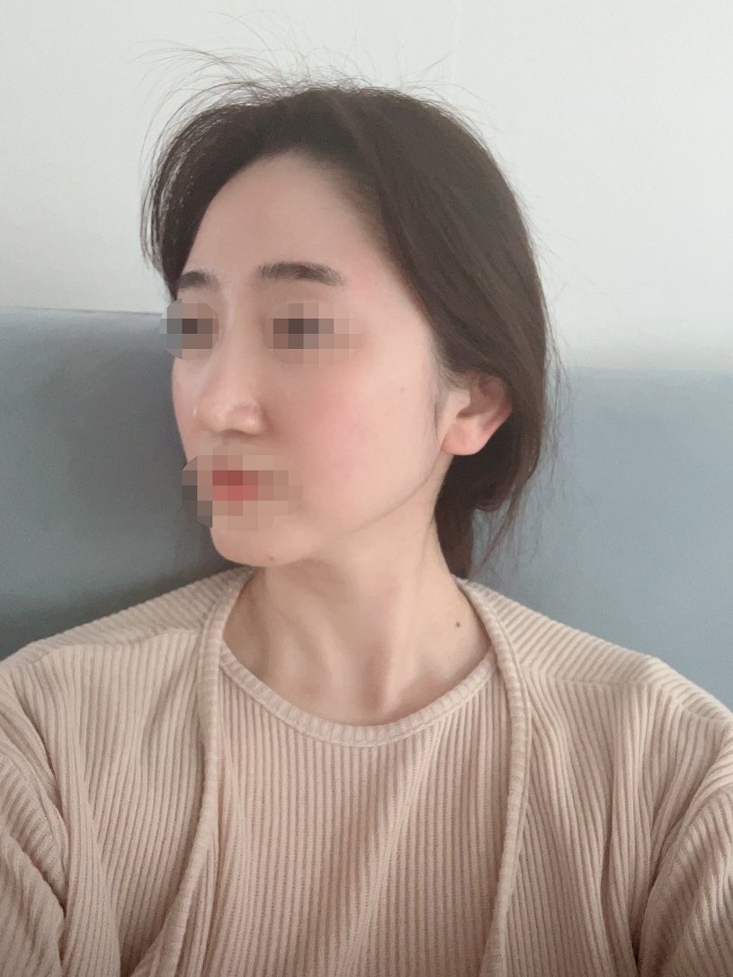 수술후기이미지