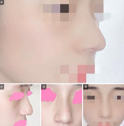 수술후기이미지