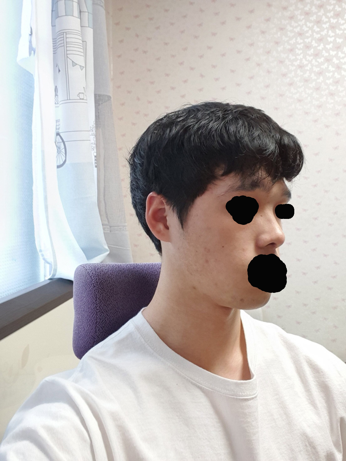 수술후기이미지