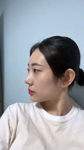 수술후기이미지