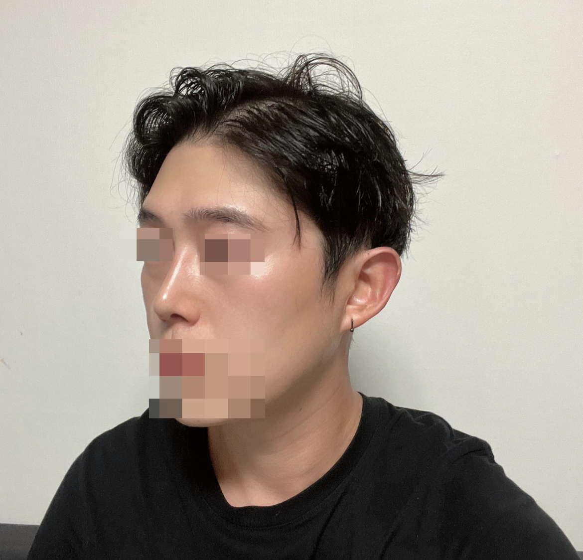 수술후기이미지