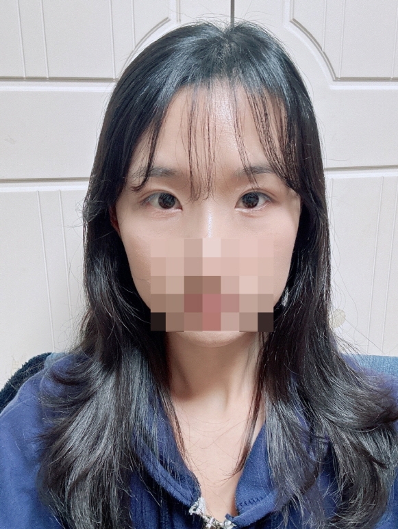 수술후기이미지