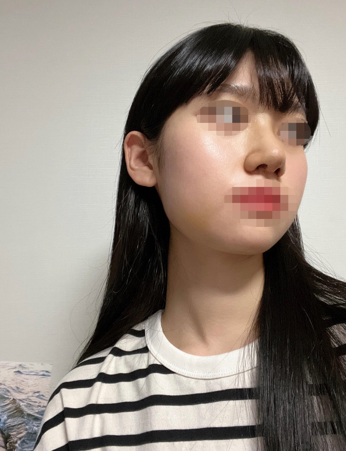 수술후기이미지