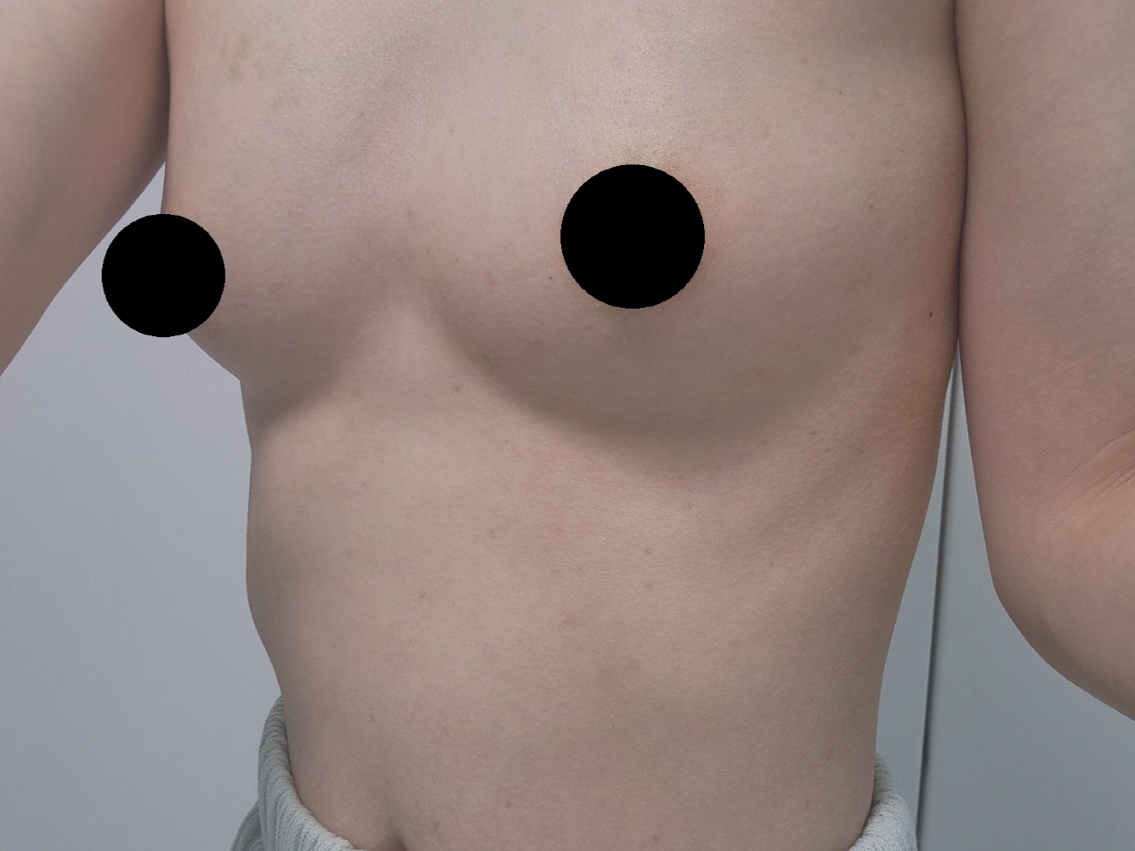 수술후기이미지