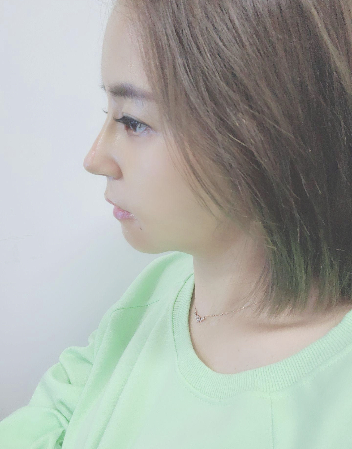 수술후기이미지