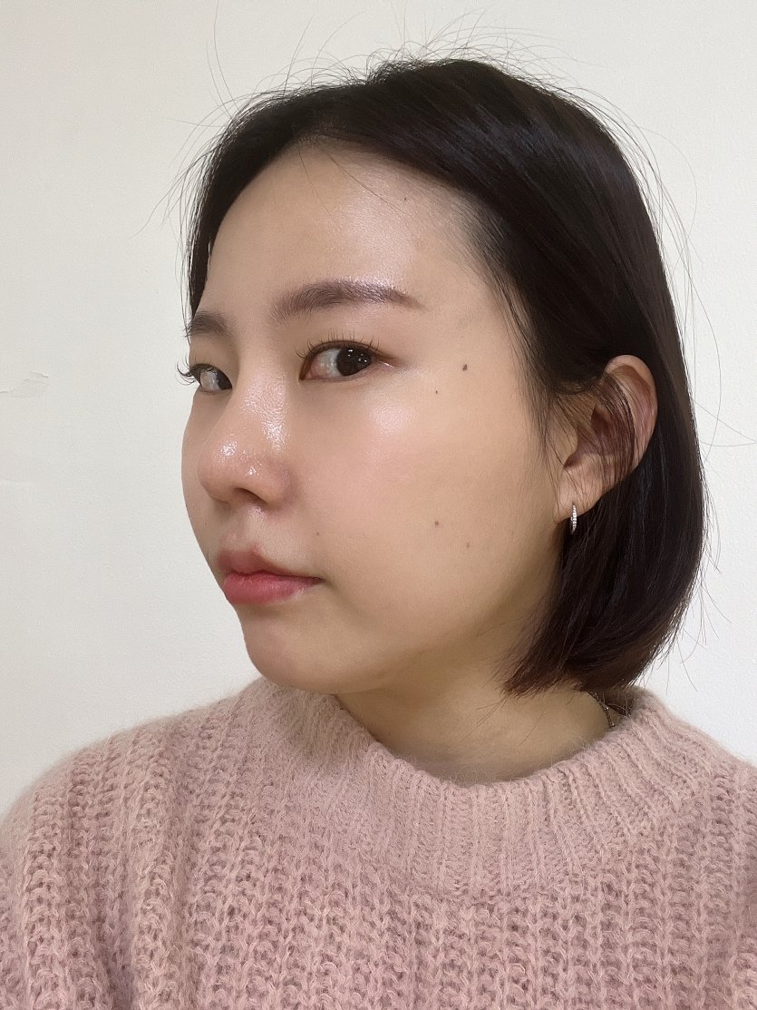 수술후기이미지