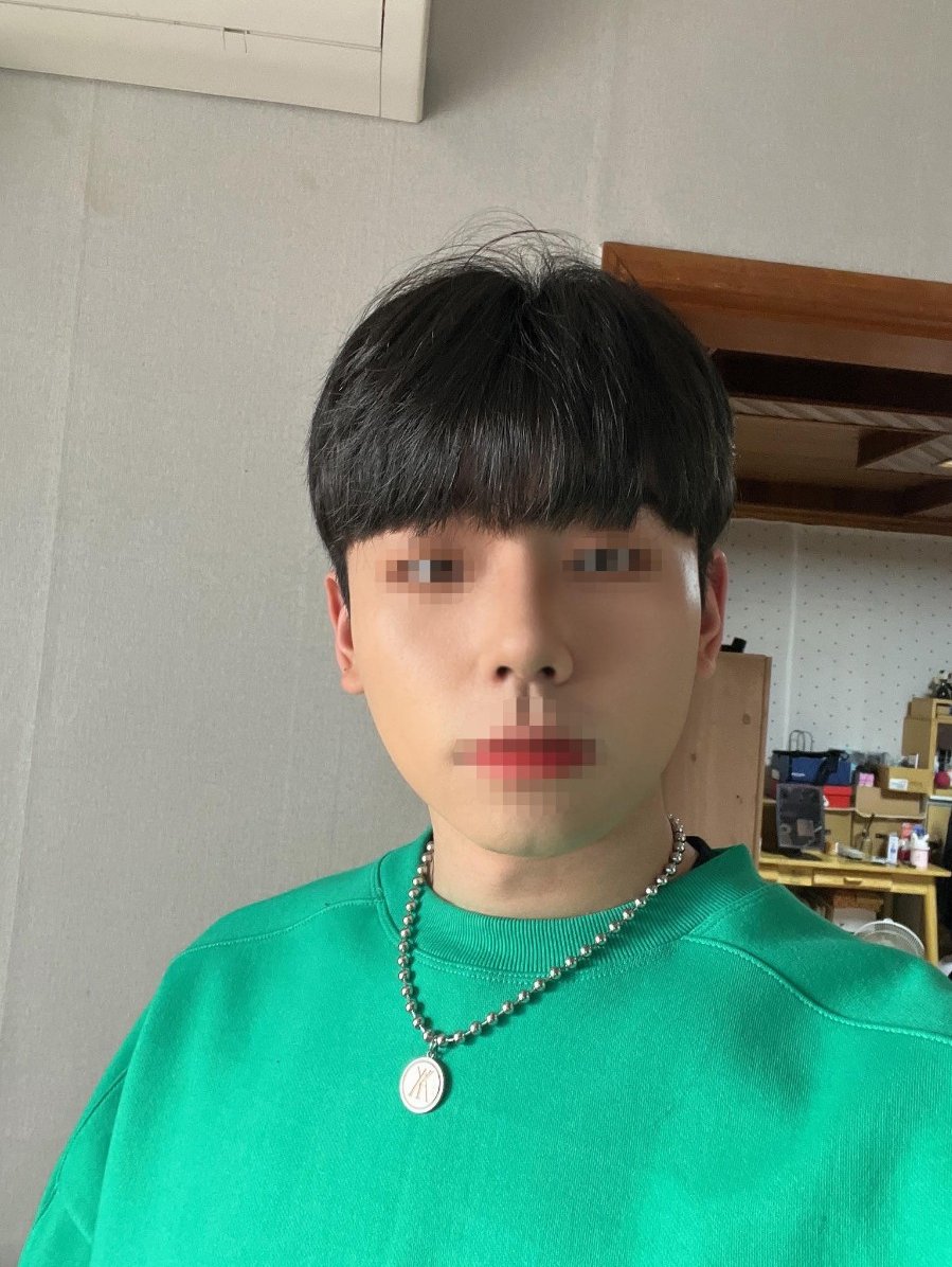 수술후기이미지