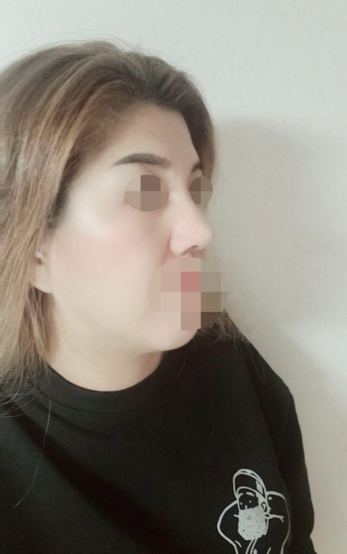 수술후기이미지