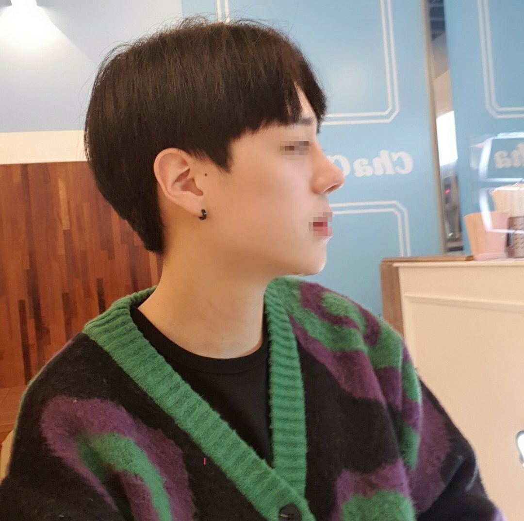 수술후기이미지