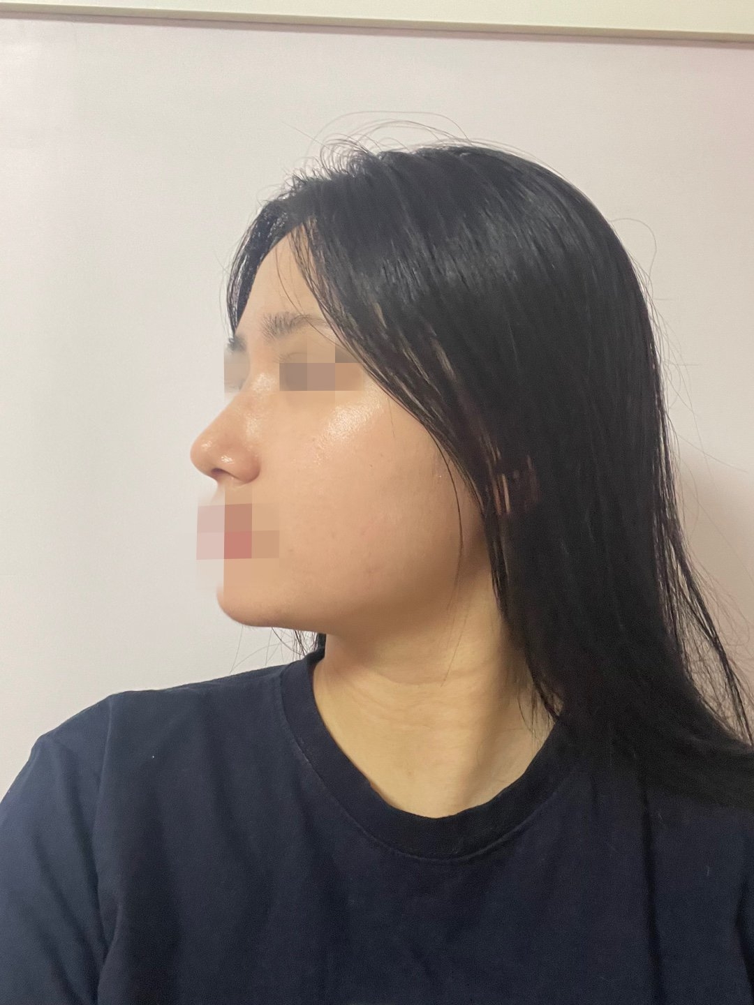 수술후기이미지