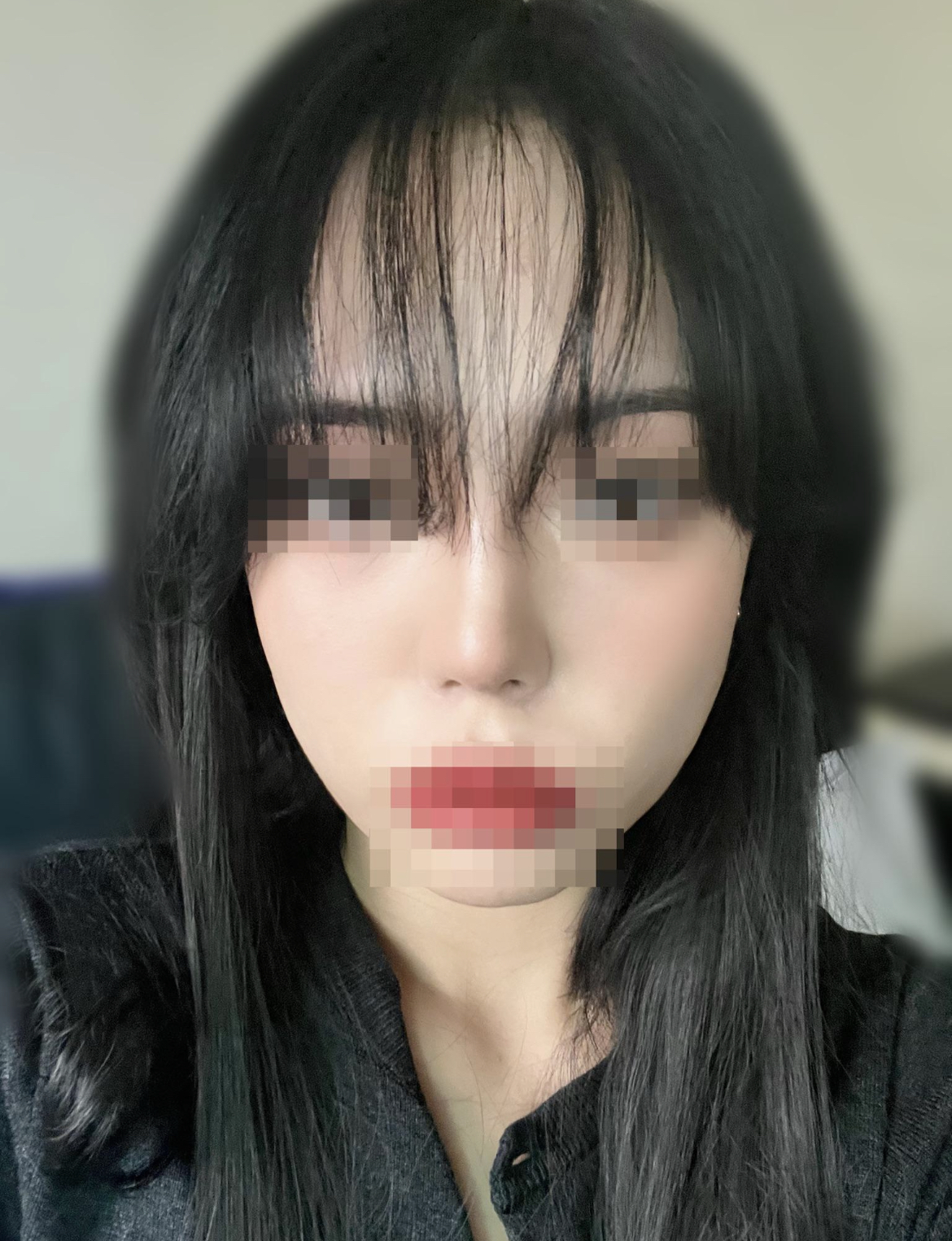 수술후기이미지