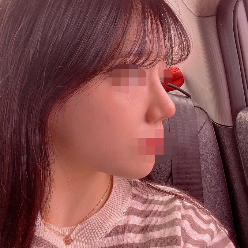 수술후기이미지