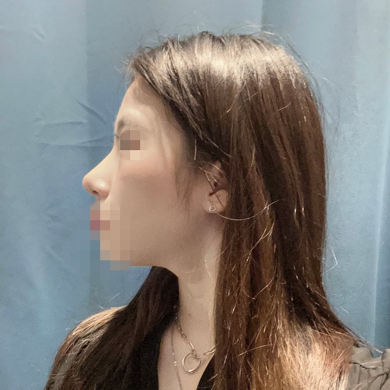 수술후기이미지