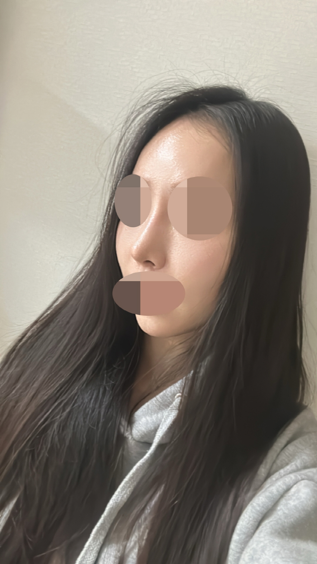 수술후기이미지