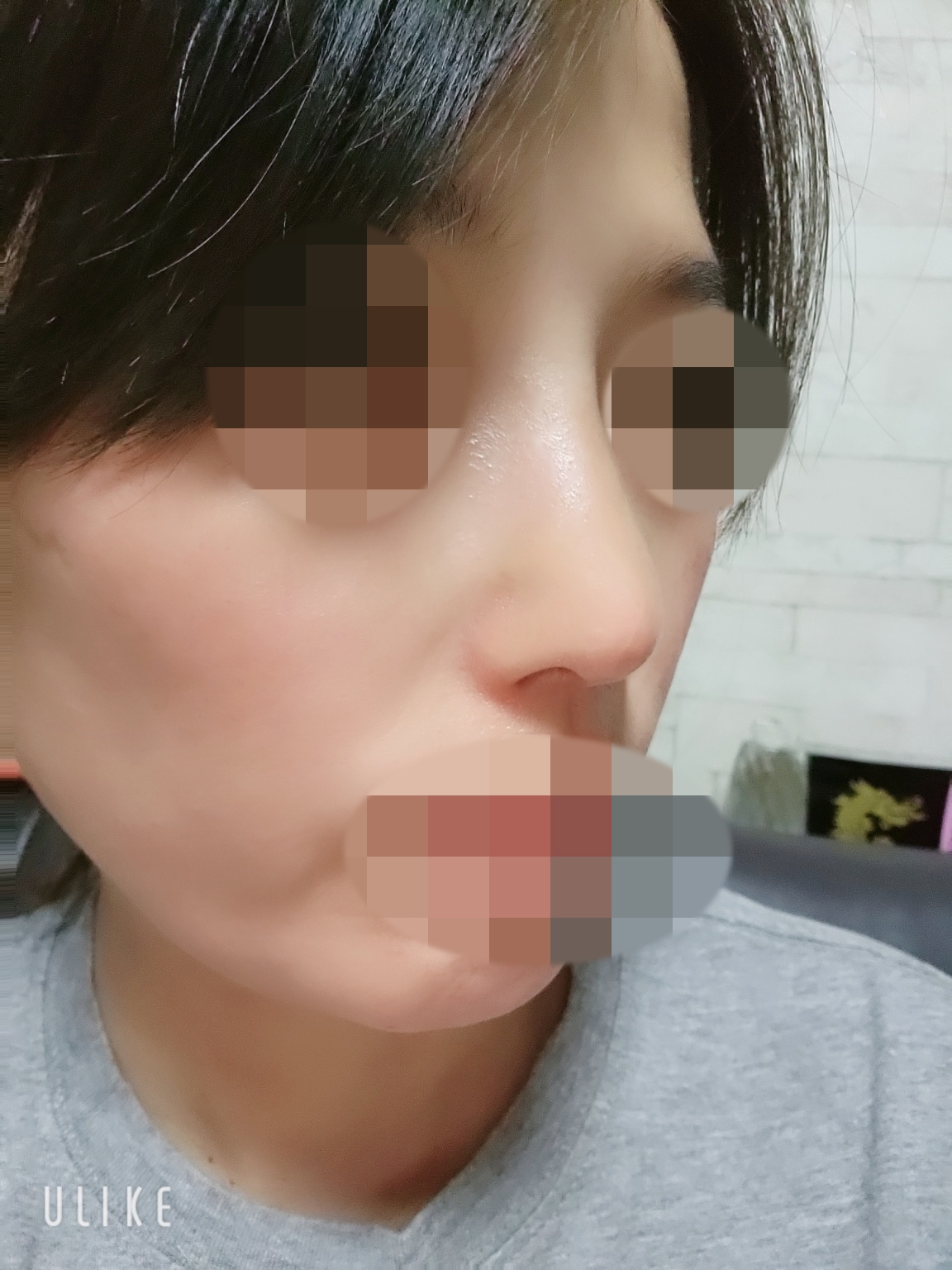 수술후기이미지