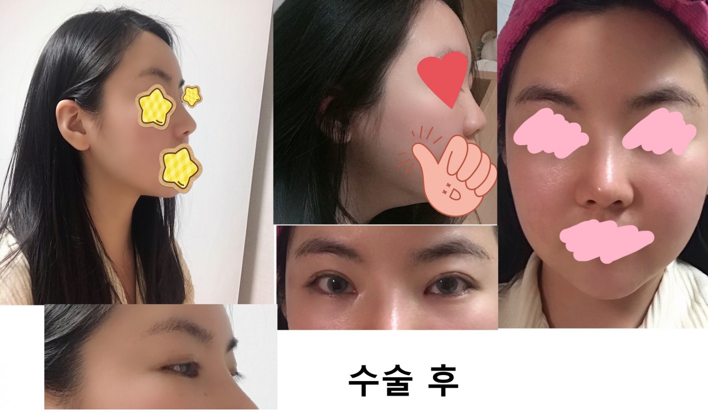 수술후기이미지