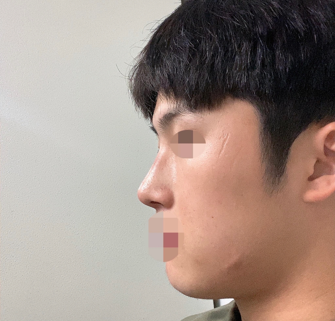 수술후기이미지