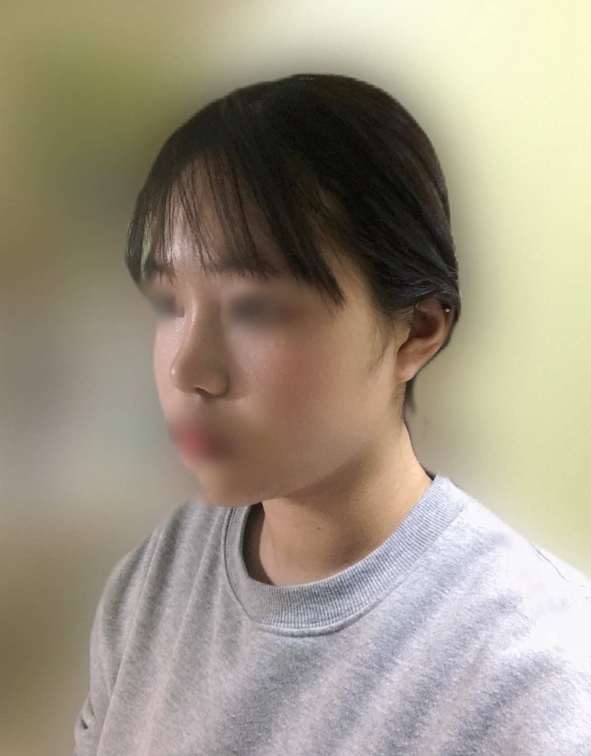 수술후기이미지