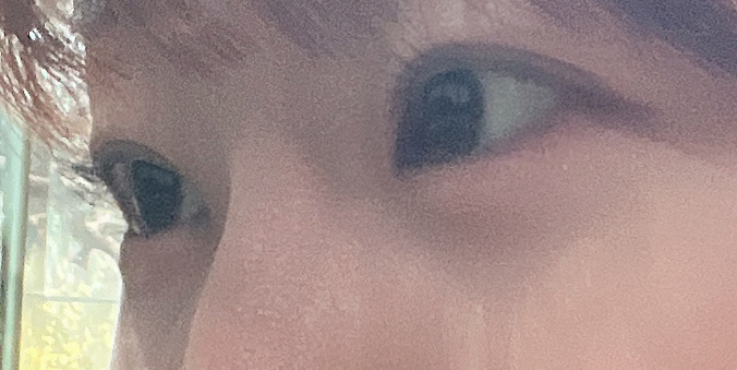 수술후기이미지