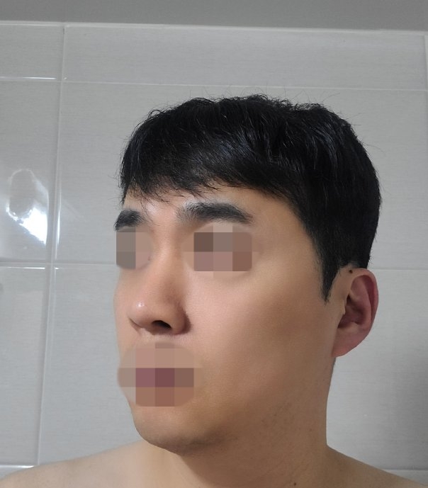 수술후기이미지