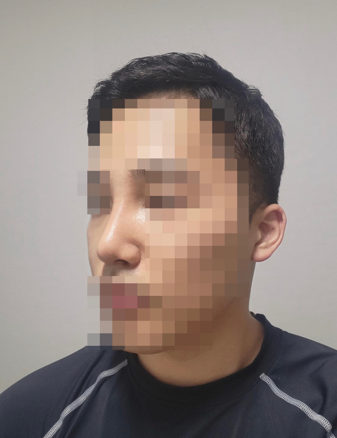 수술후기이미지