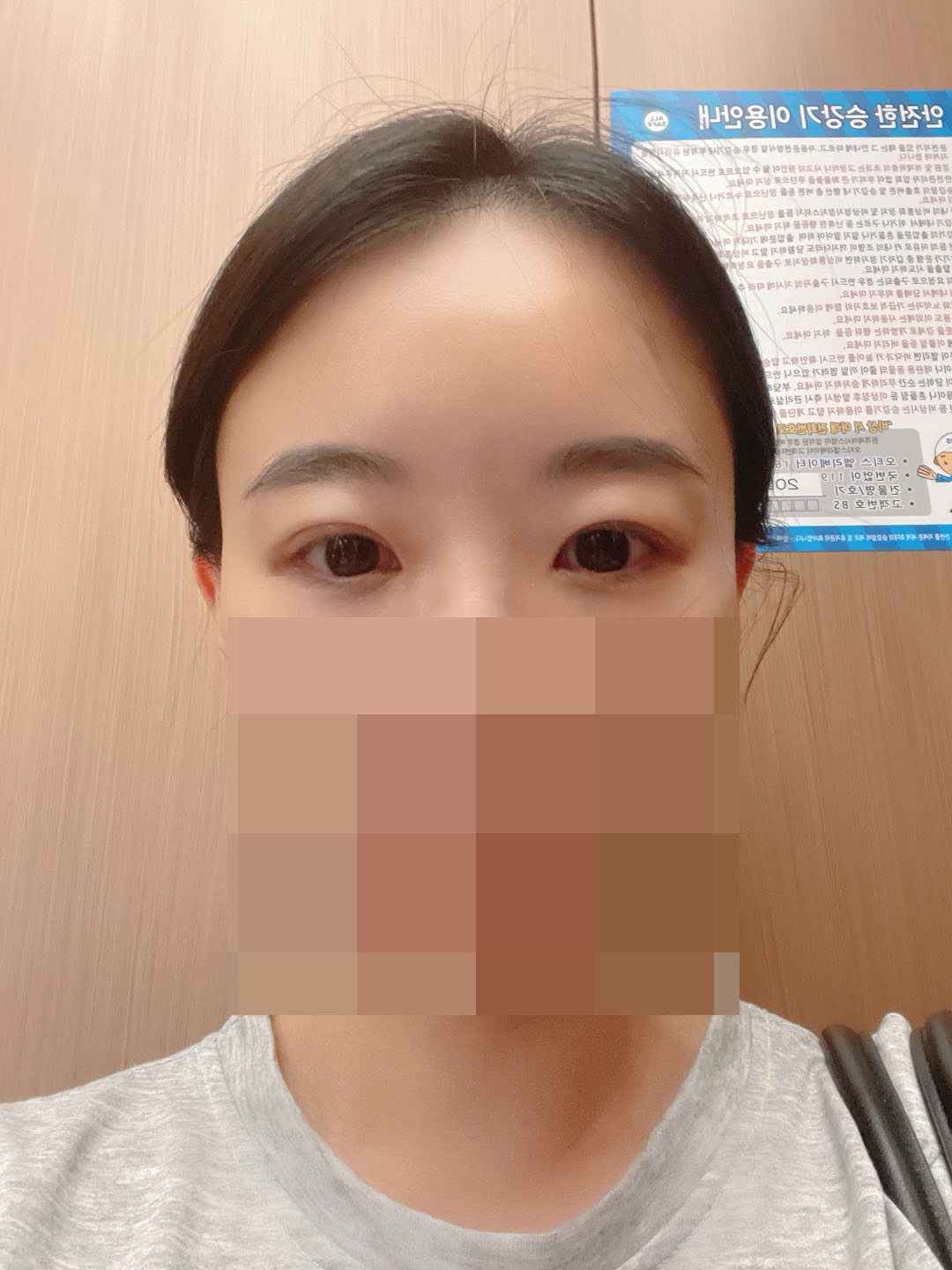 수술후기이미지