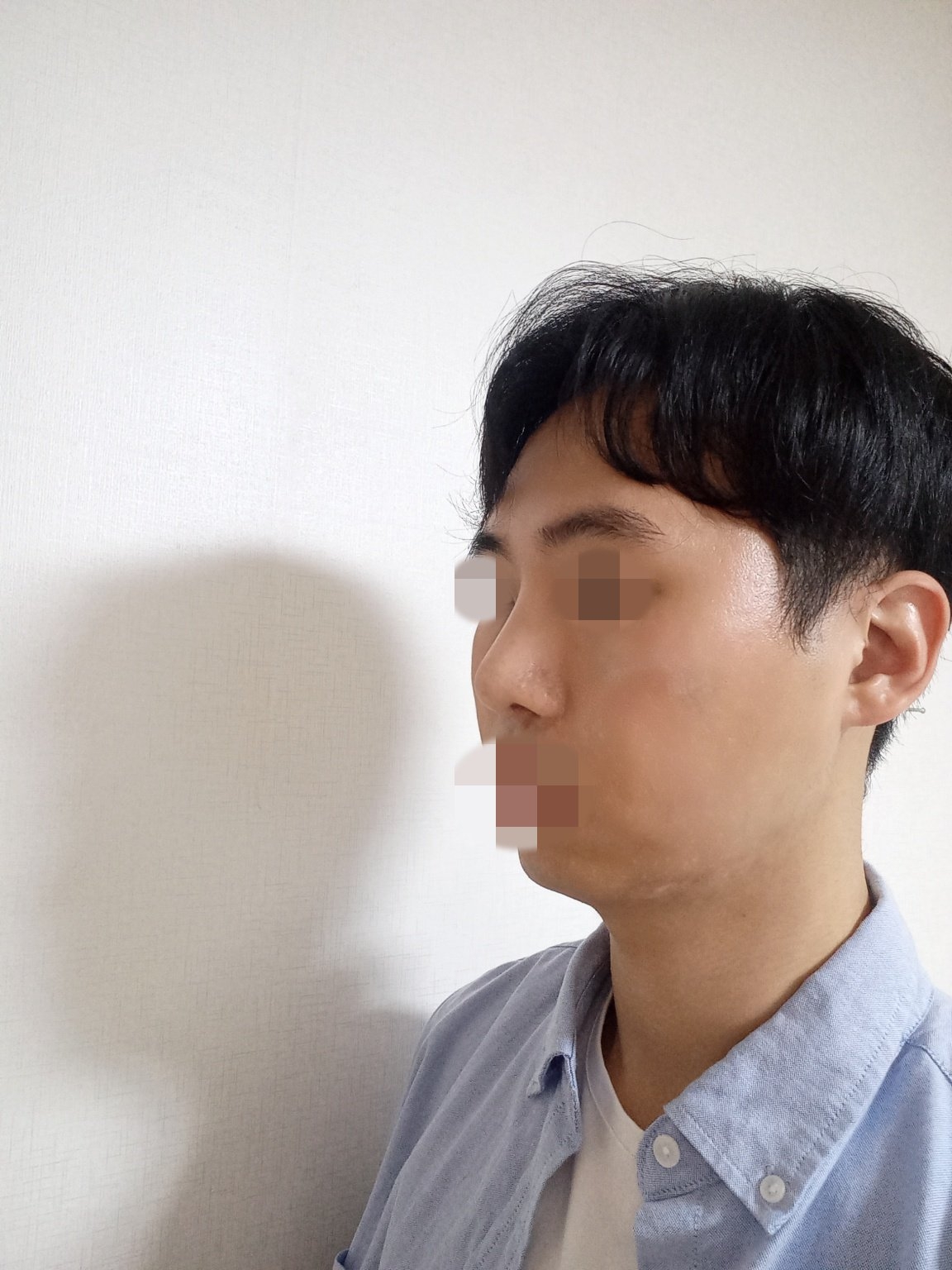 수술후기이미지