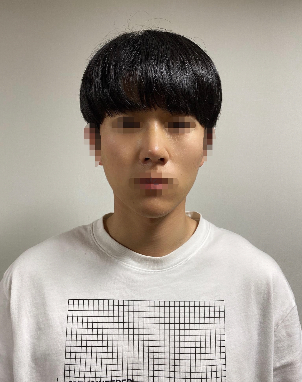 수술후기이미지