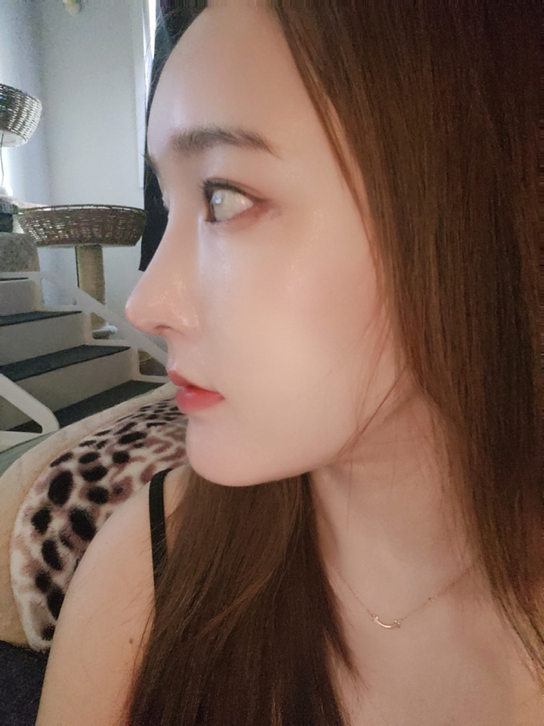 수술후기이미지