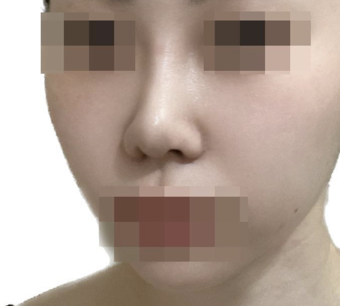 수술후기이미지