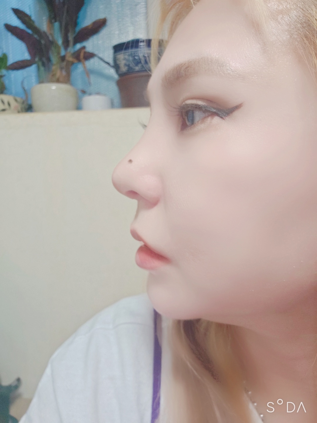 수술후기이미지