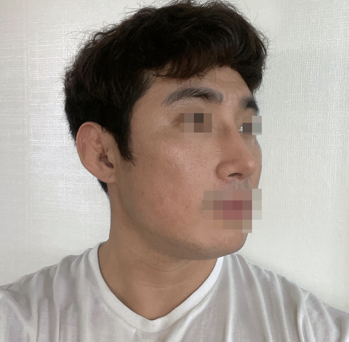 수술후기이미지