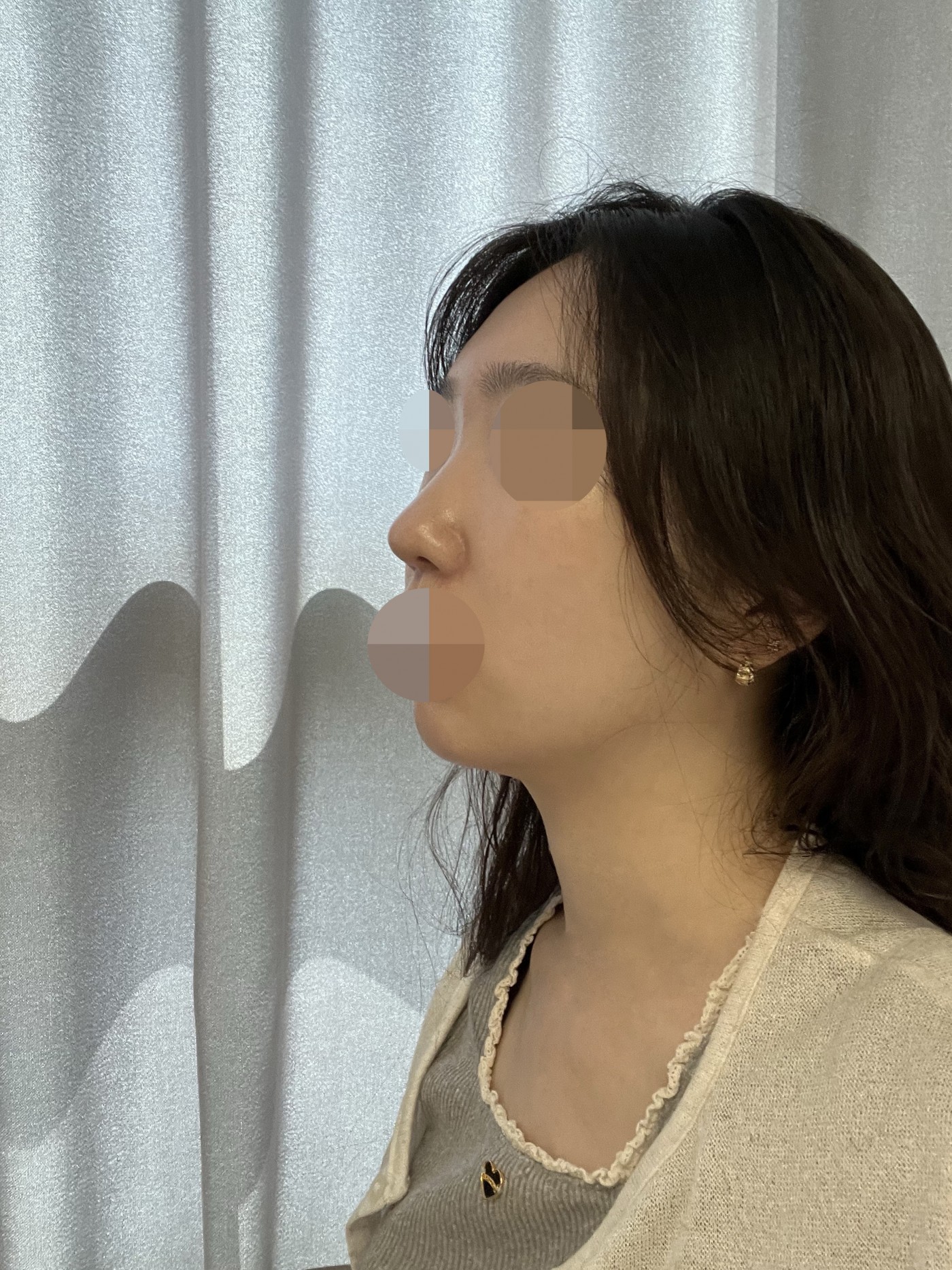 수술후기이미지