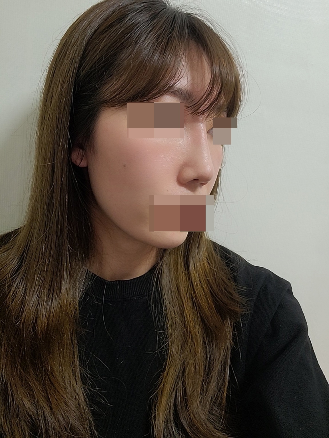 수술후기이미지