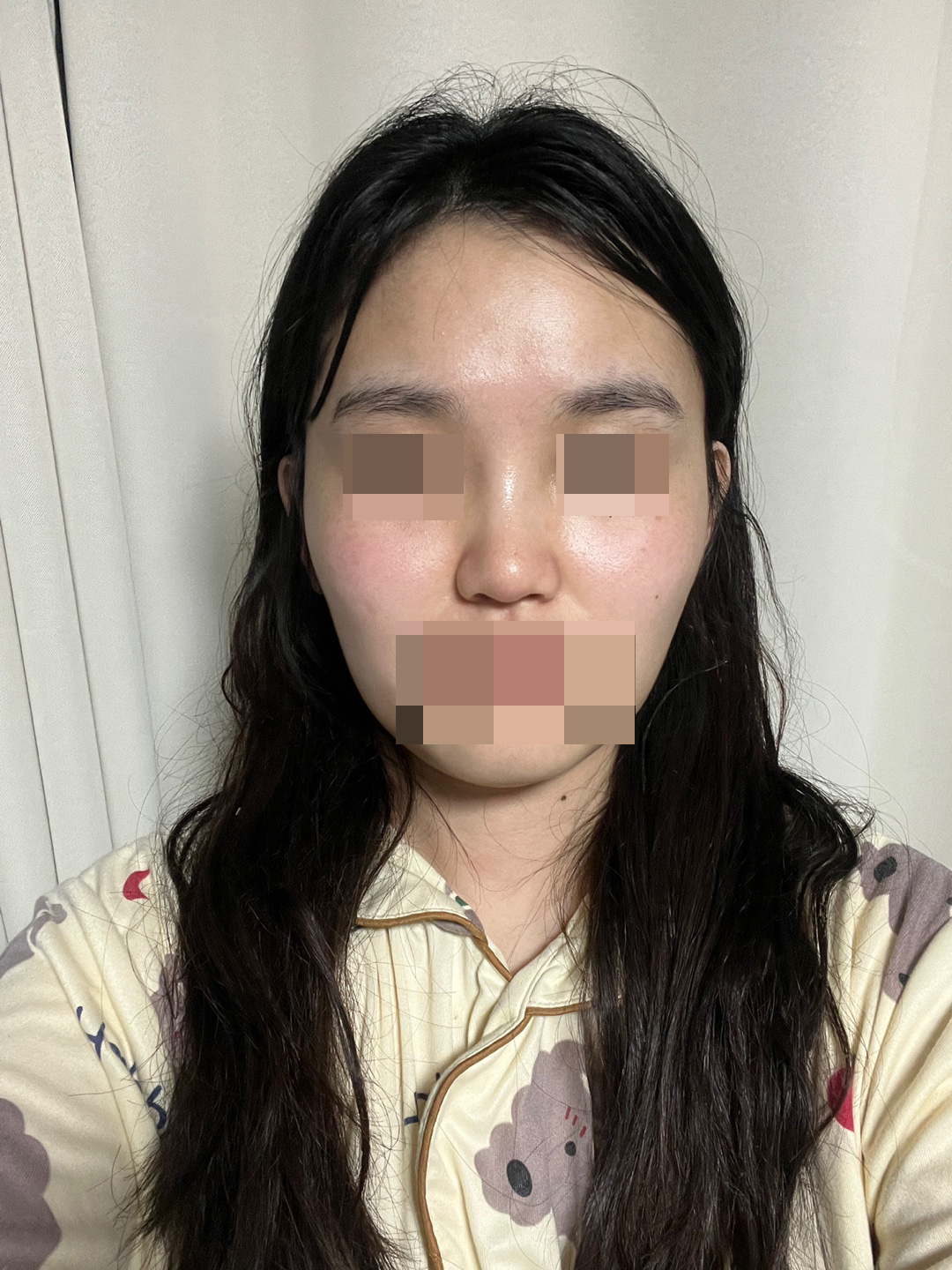 수술후기이미지