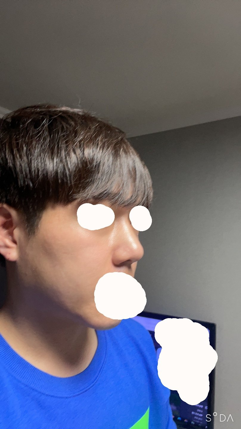 수술후기이미지