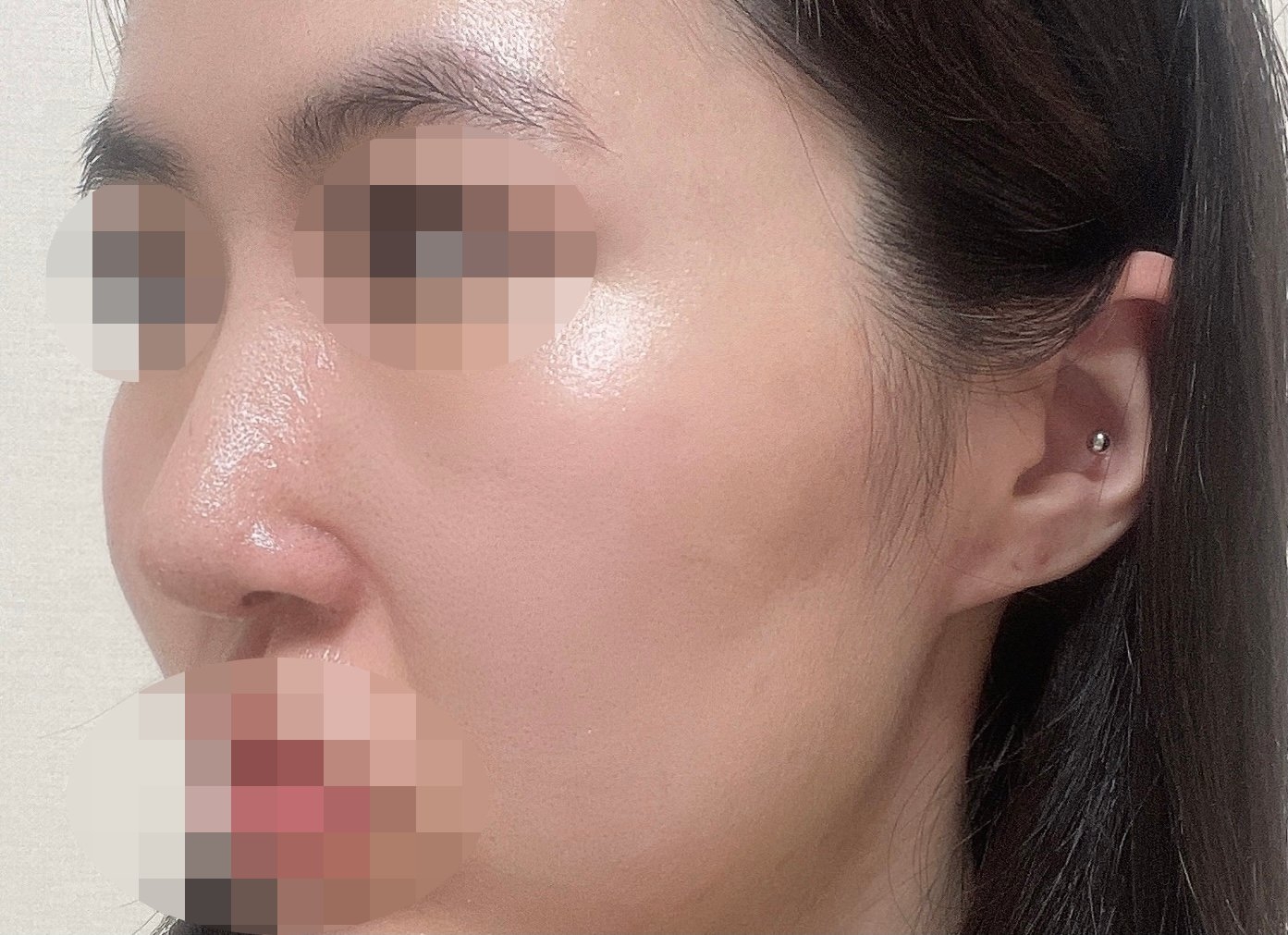 수술후기이미지