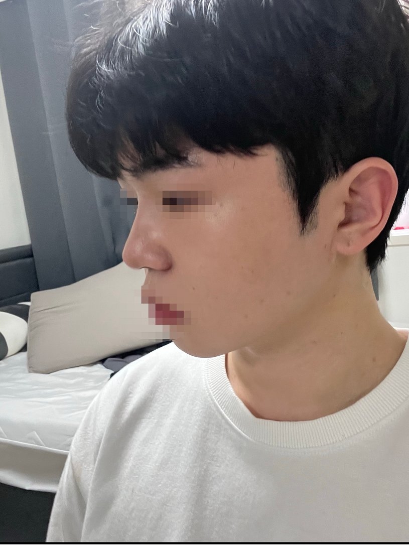 수술후기이미지