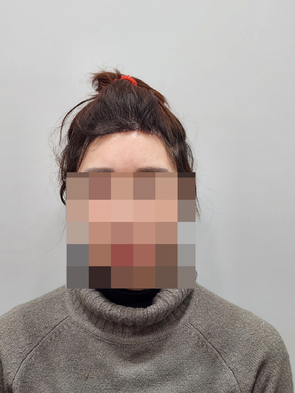 수술후기이미지