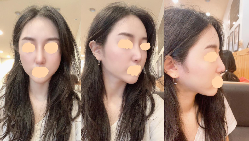 수술후기이미지