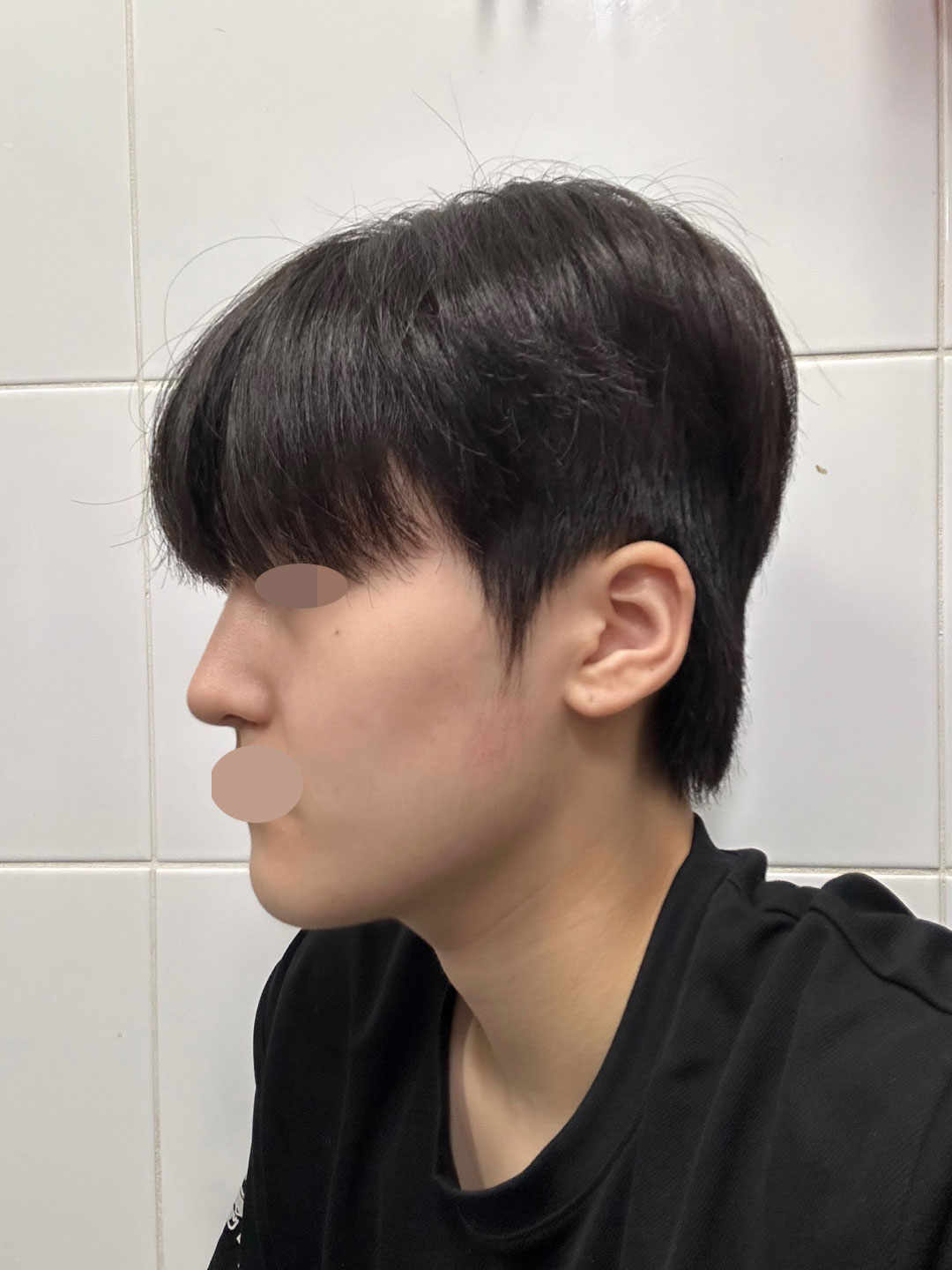 수술후기이미지