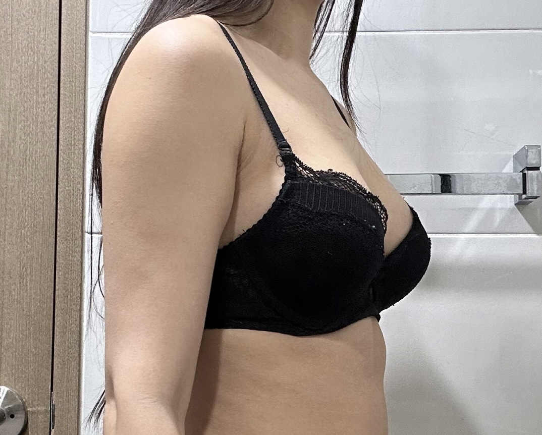 수술후기이미지