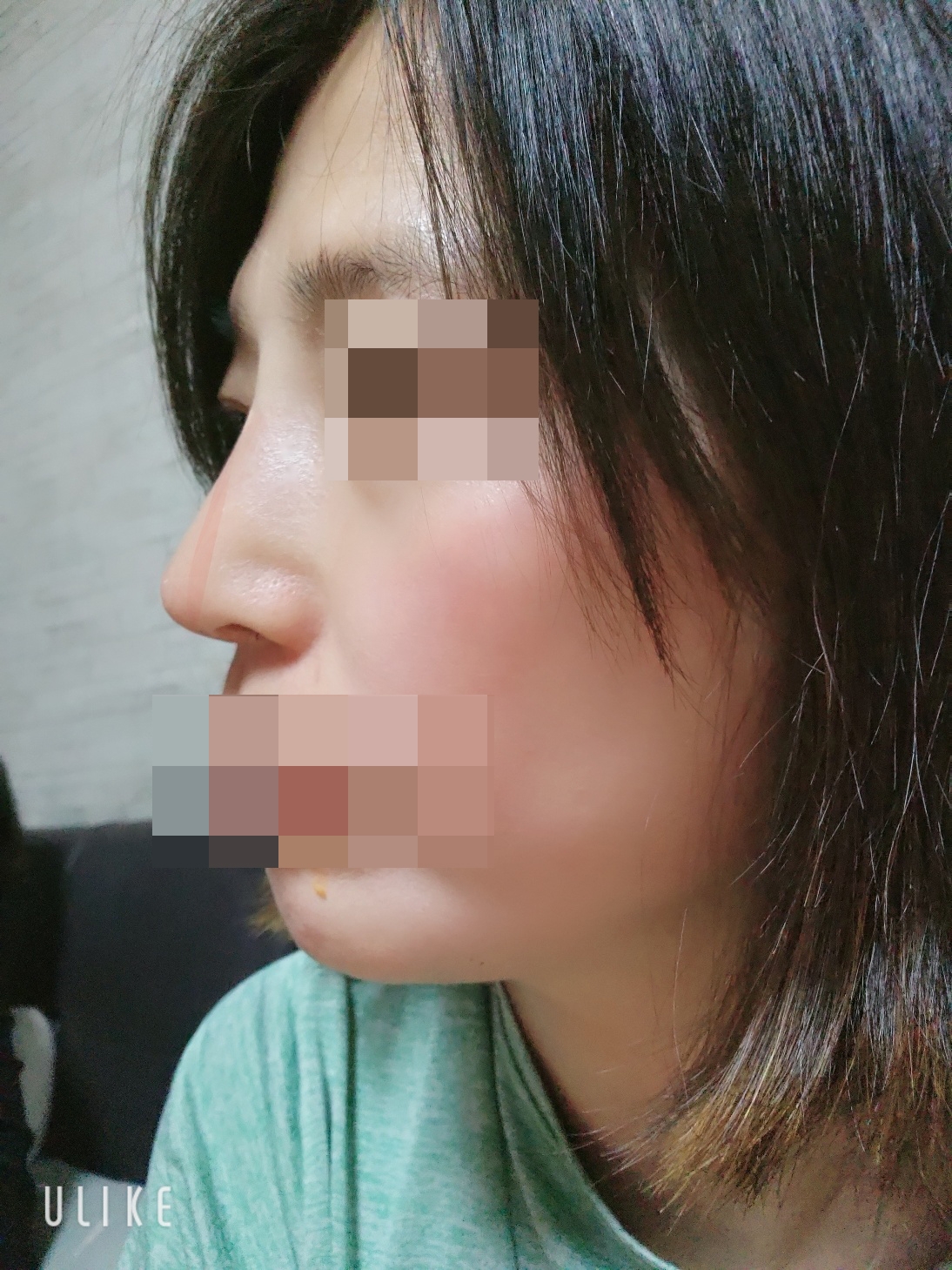 수술후기이미지