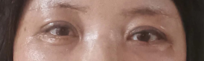 수술후기이미지