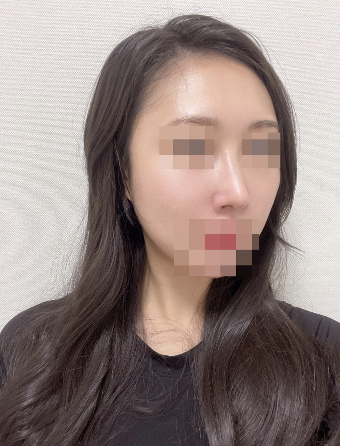 수술후기이미지