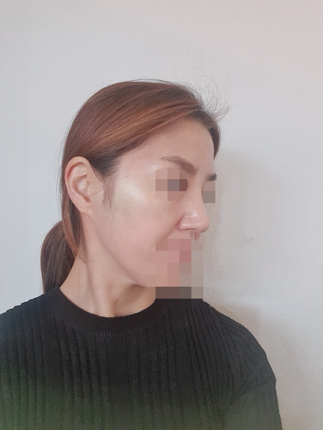 수술후기이미지